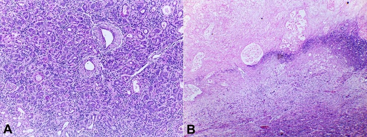 Photomicrograph of the surgical specimen. A &ndash; Lactating adenoma; proliferation of intralobular tubules and acini, closely packed and intermixed with delicate fibrous stroma. Some acini with lumina containing eosinophilic secretions (H&E, 40x); B &ndash; Microscopic appearance of grossly chalk-like area demonstrating coagulative necrosis and a hyperbasophilic rim of dystrophic calcification (H&E, 40x).