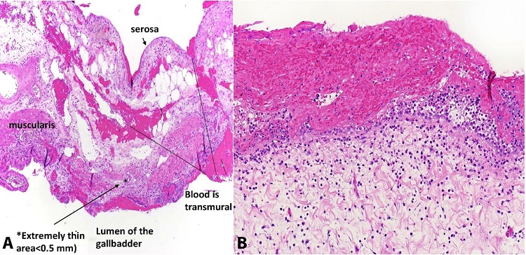 A – Photomicrographs of the gall bladder demonstrating acute on chronic hemorrhagic cholecystitis with adherent clotting and blood. In B – note fresh blood and peritonitis (not organizing serosal adhesions as would be expected in long term chronic process).