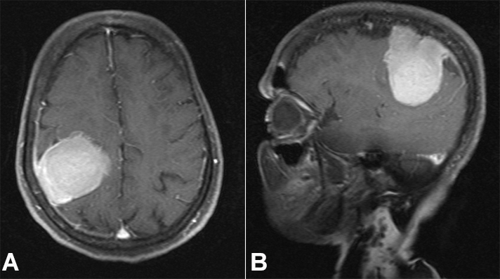 Brain MRI T1 weighted images post-contrast, A – axial plane, and B – sagittal plane, showing fat-saturated and avidly enhancing oval-shaped extra-axial lesion along the left frontoparietal convexity measuring 52mm in the longest dimension. The lesion shows a dural tail characteristic of meningioma.
