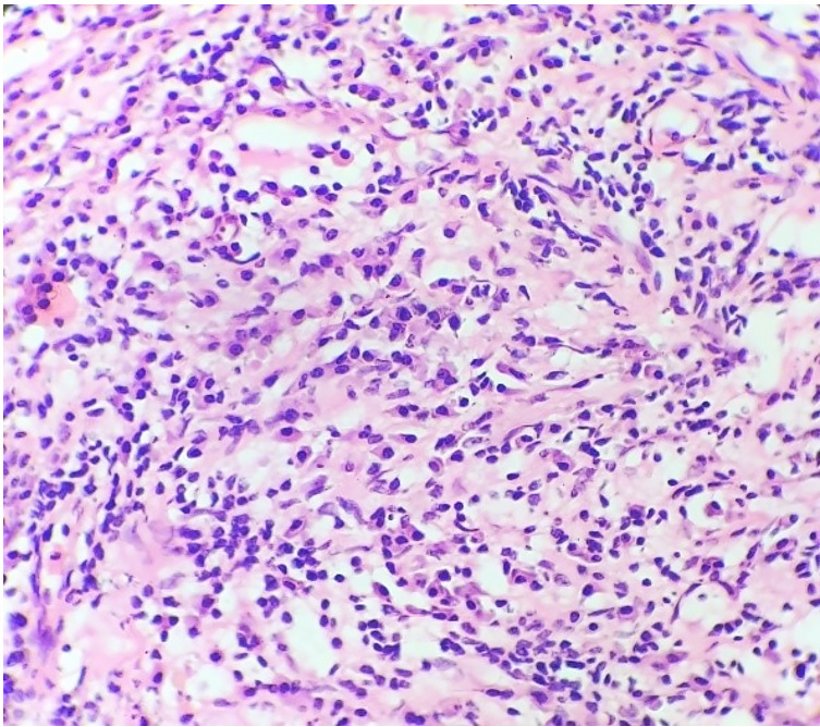 Histopathological examination with dense aggregates of inflammatory cells comprising predominantly of plasma cells (H&E, 40x).