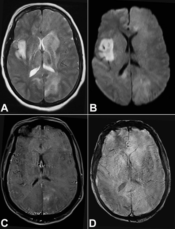 Brian MRI. A &ndash; Axial T2 weighted image shows ill-defined hyperintense signal involving bilateral basal ganglia (Left > Right), thalami, right insula, cortical and subcortical white matter in bilateral occipital lobes (Left> Right); B &ndash; Axial Diffusion weighted image shows areas of patchy diffusion restriction, more in the right insula; C &ndash; Axial T1 weighted post contrast image shows areas of mild patchy left occipital enhancement; D &ndash; Axial SWI image shows no evidence of hemorrhage