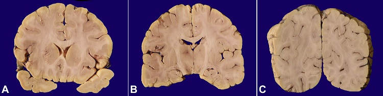 Gross view of the brain. A &ndash; Coronal section showing irregularity in left anterior limb of internal capsule extending to head of caudate; B &ndash; Prominence of intraparenchymal vessels in bilateral thalamus; C &ndash; Loss of grey-white junction noted in left striate cortex with surrounding edema.
