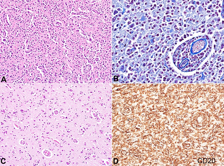 Photomicrographs of the brain. A &ndash; Low magnification of striate cortex depicting non-cohesive, atypical lymphoid cells percolating through the parenchyma (H&E x200); B &ndash; Focal areas showing a modest perivascular cuffing with finely dispersed lymphoma cells in adjacent parenchyma (Martius scarlet blue x400); C &ndash; High magnification of frontal cortex depicting fine infiltration by lymphoma cells (H&E x400); D &ndash; Strong diffuse immunopositivity of neoplastic cells with CD20 (immunoperoxidase x400).