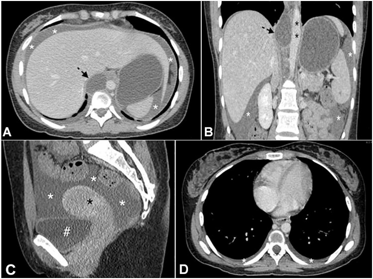 Thoracic and abdominal enhanced computed tomography. A &ndash; axial plane and B coronal plane &ndash; images at admission showing a cystic image (black arrow) in the thoracic duct site at the thoracic-abdominal transition, well-defined and without enhancement in contact with the aorta (black asterisk), and associated with ascites (white asterisks), C &ndash; sagittal plane and D axial plane showing ascites (white asterisks) and bilateral laminar pleural effusion, as well as the bladder (#) and the uterus (black asterisk).