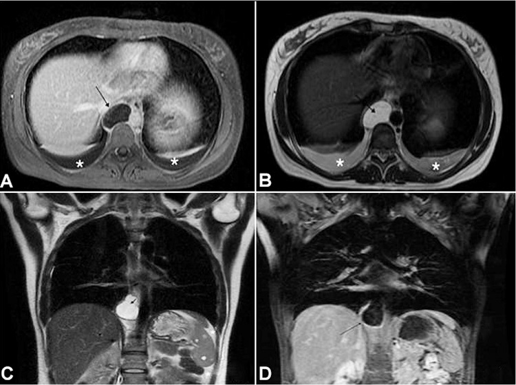 Axial MRI sections of the chest showing a cystic image in the topography of the thoracic duct (arrow) characterized by A &ndash; a low signal in the T1-weighted sequence; B &ndash; a high signal in the T2-weighted sequence; associated with C &ndash; small pleural effusion and ascites (asterisks); the cyst is also evident (arrow) in the coronal section on the T2-weighted sequence, and D &ndash; without enhancement in the T1-weighted sequence after contrast injection.
