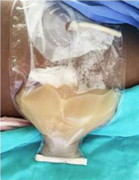 Gross view of the milky-like liquid collected on the drainage of the ascites.