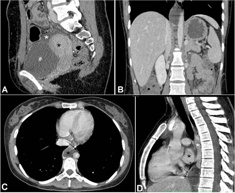 Contrast-enhanced CT scan of the abdomen after drainage, A &ndash; shows a significant reduction in ascites (white asterisk) and partially drainage (arrow) in the sagittal plane, in addition to the uterus (black asterisk) and the bladder (#); B &ndash; the coronal section image, confirms the total regression of ascites detected in the admission exam; C and D &ndash; Contrast-enhanced chest CT scan after drainage, C - axial section, and mediastinal window shows the close relationship between the cyst and the thoracic duct (black asterisk) and other structures such as the descending aorta (#), the azygous vein (white asterisk) and the esophagus (arrowhead); it also reveals the absence of pleural effusion; D - sagittal section shows the major diameter of the cyst at the site of the thoracic duct (long arrow), its location in the posterior mediastinum and the relationship with the esophagus (short arrow), the right ventricle (black asterisk), and the azygous vein (white asterisk).