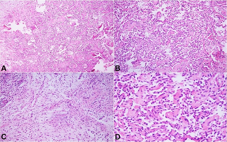 Photomicrograph of the biopsy showed: A – biphasic tumor comprising of fibrous as well epithelial component (H&E,10X); B – epithelial component disposed mainly in a glandular pattern along with cords (H&E,20X); C – shows an area of fibrous component (H&E,20X); D – Higher magnification shows round to oval epithelial cells with bland nuclear features and mild to moderate cytoplasm, No pleomorphism (H&E,40X).
