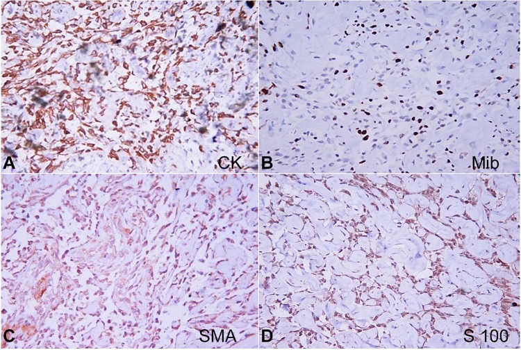 Photomicrographs of the IHC study on the biopsy specimen. A – CK positive; B – Mib proliferation index 20-30%; C – SMA – negative; D – S100 equivocal. (all pictures 40X).