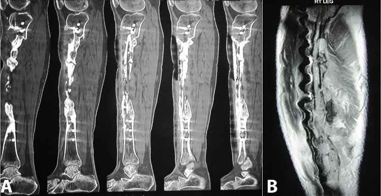 CT study of right leg: A – Sagittal sections reveal multiple patchy cortical erosions/irregularities in the right tibia centered in the diaphysis and contiguously involving the adjacent upper metaphysis. Note adjoining soft tissue thickenings. Streak artifacts are noted due to postoperative changes (Screws); B – MRI Sagittal section of right leg reveals cortical erosions/irregular outlines of the tibia with altered signals in the adjoining bone marrow and soft tissue. Susceptibility artifacts are noted due to postoperative metallic screws.