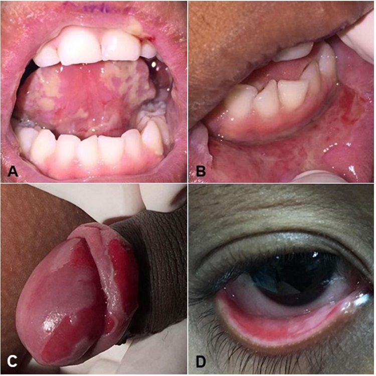 Lesions at the first appointment. A &ndash; Ulcerative lesions in the ventral surface of the tongue; B &ndash; Lesions with an ulcerative surface in lower labial mucosa (biopsy site); C &ndash; Ulcers in glans and foreskin; D &ndash; Ulcer in the mucosa of the lower eyelid.