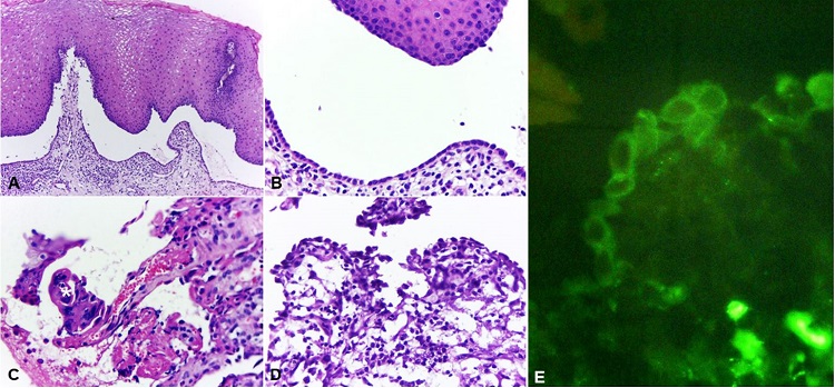 Photomicrographs of the biopsy specimen. A &ndash; Intraepithelial blister with a single layer of basal cells recovering the conjunctive tissue and lymphoplasmacytic inflammatory infiltrate with eosinophils (H&E, 5X); B &ndash; High magnification of image A (H&E, 20X); C &ndash; Ulcered area with grouped acantholytic cells (*) with degenerative alterations (H&E, 40X); D &ndash; View of the inferior area of epithelial blister and suprabasal slit showing tiny area with rare basal cells still attached to the conjunctive tissue (H&E, 40X); E &ndash; Positive direct immunofluorescence showing IgG3 in the intercellular space of cells of the remaining epithelium basal layer on the conjunctiva.