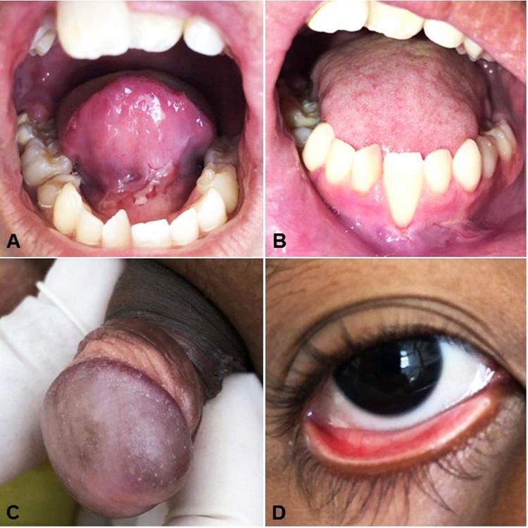 Lesions on the last follow-up. A &ndash; Ulcerative lesions in the ventral surface of the tongue; B &ndash; Ulcers in the transition between alveolar mucosa and lower labial mucosa; C &ndash; Remission of lesions in glans and foreskin; D &ndash; Absence of lesion in the lower eyelid.