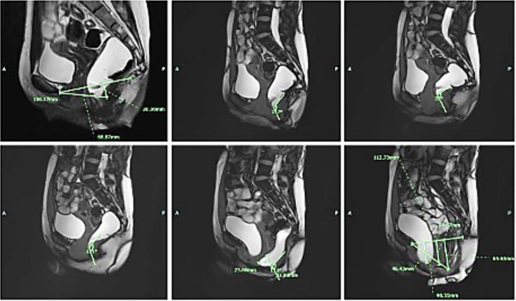 MRI defecography. Findings were suggestive of tricompartmental pelvic floor prolapse, moderate size anterior rectocele, and grade 2 sigmoidocele.