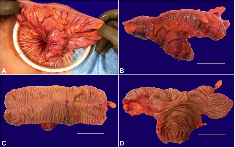Gross examination of the sigmoid colon. A &ndash; Broad-based diverticulum is seen in the sigmoid colon likely presenting a tubular duplicated colon that shares a common opening with the sigmoid colon; B &ndash; Gross pathologic examination of the resected segment of the sigmoid colon shows a longitudinal outpouching located at 4.3 cm away from the closest resection margin, making a 30-degree angle with the sigmoid colon segment, and measuring 7.3 cm in length and 2.6 cm in average diameter (scale bar = 5 cm); C and D &ndash; The colon segment is opened to reveal tan pink mucosa with appropriate colonic mucosal folds in both the sigmoid colon and colonic duplication segments (scale bars = 5 cm).