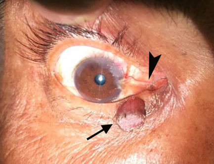 Gross view of the swelling in the right lower eyelid (arrow) along with a fleshy growth in the conjunctiva (arrowhead) of the same eye encroaching upon the cornea.