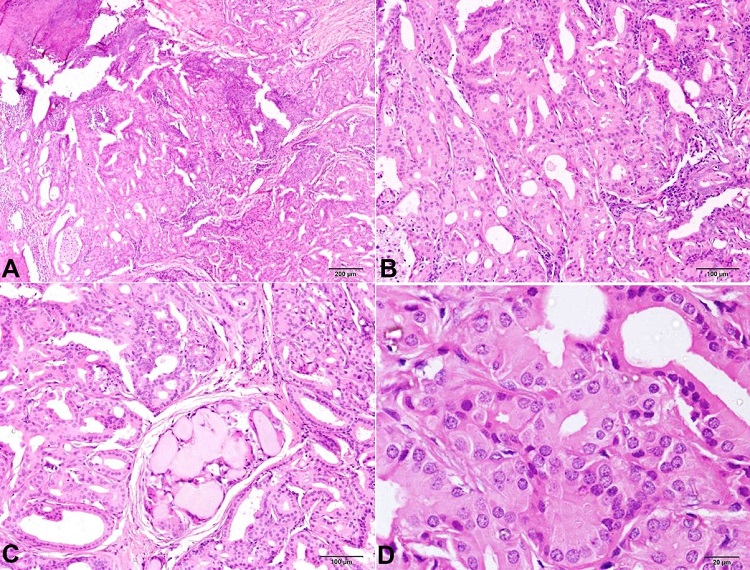 Photomicrograph of the eyelid lesion demonstrates glandular spaces lined by tall cells exhibiting uniform round to oval nuclei, fine chromatin, and abundant granular eosinophilic cytoplasm (oncocytes). At places, there was evidence of secretion within the glandular spaces and interspersed lymphoplasmacytic inflammation (H&E, A – 4X; B – 10X; C – 10X; D – 40X).