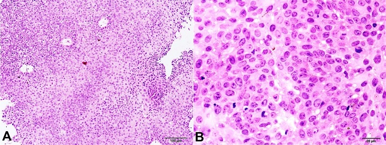 Histopathology of the conjunctival lesion exhibits a superficial biopsy comprising only acanthotic stratified squamous epithelium displaying severe dysplasia (H&E, A – 10X; B – 40X).