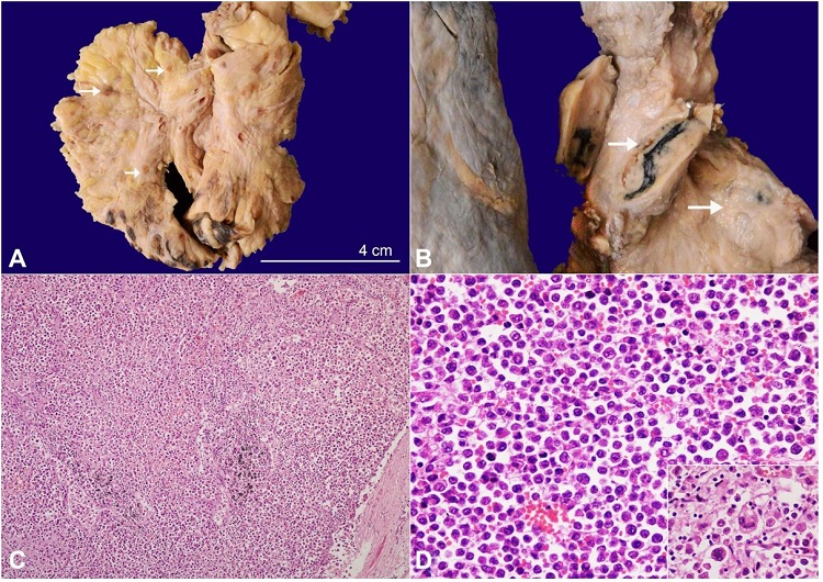A – Gross view of the mesentery showing multiple enlarged lymph nodes (arrow); B – Gross view of the enlarged mediastinal and hilar lymph nodes (arrow). The cut surface of the lymph node is solid, and tan-yellow; C and D – Photomicrographs of a lymph node ; C– showing diffuse and sinusoidal pattern of infiltration by neoplastic lymphoid cells (H&E, 40X); D -The tumor cells are large round with abundant eosinophilic cytoplasm and enlarged hyperchromatic to vesicular nuclei. The inset shows characteristic hallmark cells with horseshoe and multilobed nuclei (H&E, 200X).