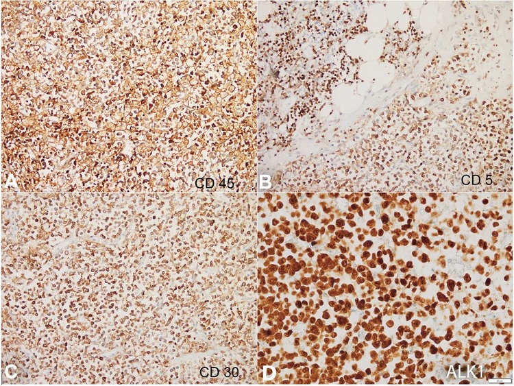 Photomicrographs of the lymph node. The tumor cells show diffuse expression of CD45 (A, 200X), CD5 (B, 200X), CD30 (C, 200X) and ALK1 (nucleocytoplasmic, D) (400X).