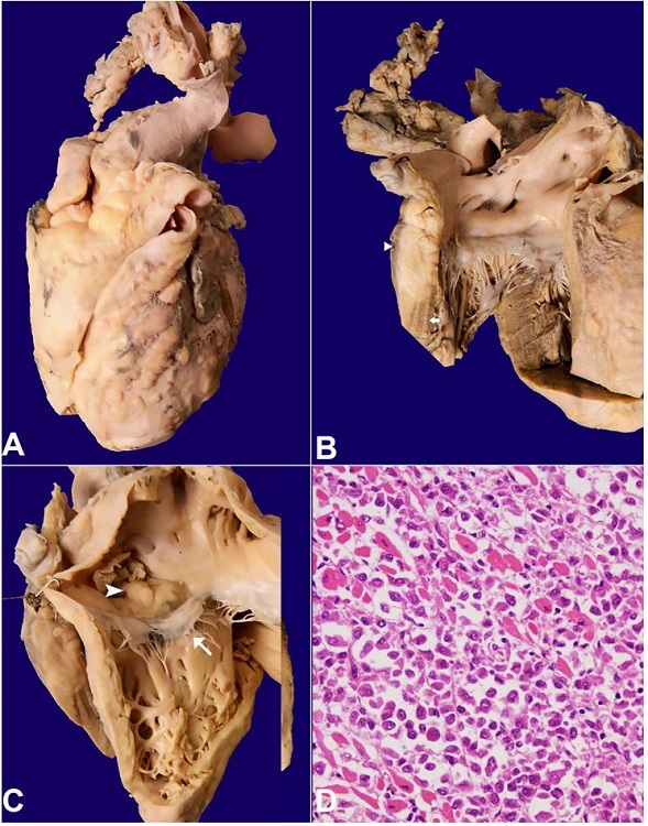Gross view of the heart in A– Anterior view with multiple solid firm nodular tumor deposits involving both the ventricles and atria; B– View of left ventricular inflow tract showing a segment of the lateral wall with the near-complete replacement of normal myocardium (arrow) by the tumor (arrowhead); C– View of right ventricular inflow tract showing multiple nodular tumor infiltration involving right atrium and ventricle. A polypoidal mass of tumor (arrowhead) was seen in the right atrial cavity above the septal leaflet of the tricuspid valve (arrow); D – Microscopic image shows predominantly tumor cells infiltrating the cardiac myocytes (H&E, 200X).