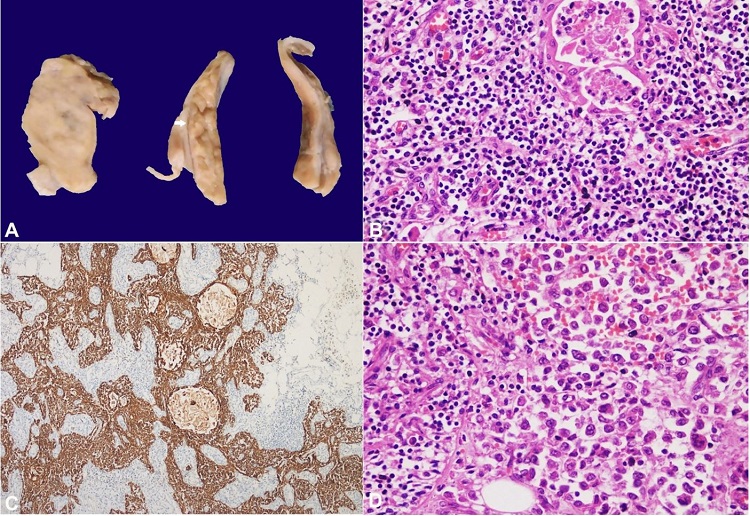 A– Gross image of the cut surface of the anterior mediastinal mass showing solid, tan-brown tumor (left) and lobulated normal-looking thymus (arrow); B– Microscopic image from normal-looking areas showing Hassall’s corpuscles and small lymphocytes (H&E, 200X); C– PanCK immunostain highlighting the epithelial network of the thymus (IHC, 100X); D– Infiltration of the thymic parenchyma (left) by the tumor cells (right) (H&E, 200X).