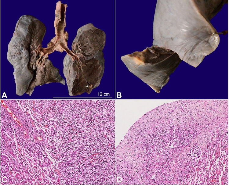 A– Gross image of the lungs showing pleural dullness and patchy consolidated areas. A single tan-yellow tumor deposit is also noted in the lower lobe (arrow); B– Closer view of a solid, yellowish subpleural tumor deposit; C– Microscopic image showing infiltration of the tumor cells in the alveolar cavity as well as the interstitium (H&E, 100X); D– The overlying visceral pleura is also infiltrated by the neoplastic cells (H&E, 100X).