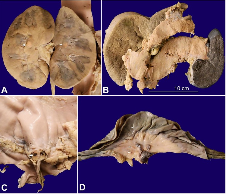 Gross view of: A– single yellowish tumor nodule in the medulla of the kidney (arrows); B– The pancreas is bulky and the peripancreatic lymph nodes are enlarged (arrows); C– The serosal surface of the stomach is irregular and shows yellowish-brown tumor deposit (arrow); D– The visceral peritoneum of small intestine and mesentery show tiny tumor deposits (arrows)