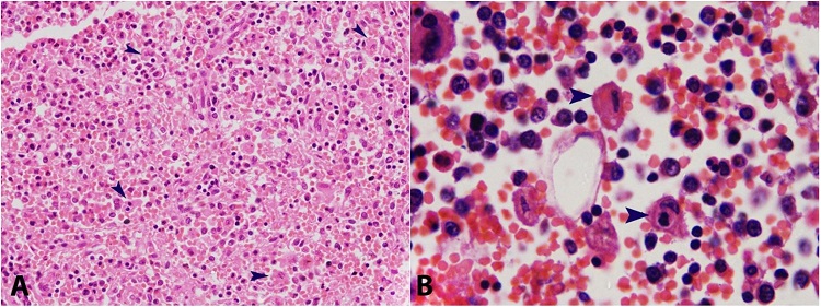 A– Photomicrograph of the spleen showing increased histiocytes and hemophagocytosis (arrowhead) (H&E, 200X); B– Photomicrograph of the bone marrow showing hemophagocytosis (arrowhead) (H&E, 1000X).