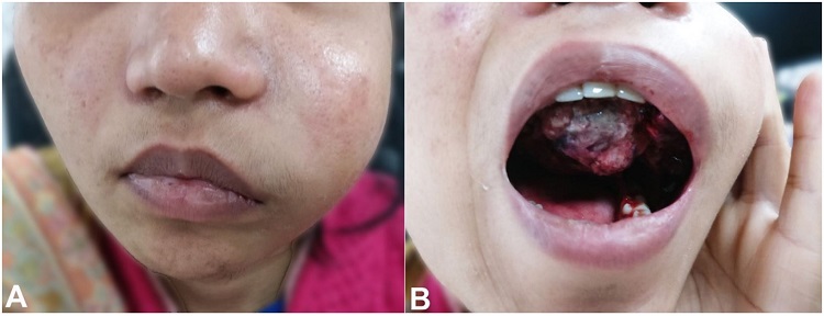 A and B &ndash; Physical examination findings showing marked swelling in the left cheek with upper alveolus and palate involvement.