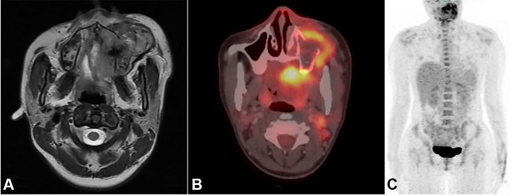 A &ndash; MRI T2 weighted image displaying the tumor extension; B &ndash; PET-CT scan demonstrating a fluorodeoxyglucose (FDG) avid tumor; C &ndash; Whole body positron emission tomography-computed tomography (PET-CT) scan without distant metastases.