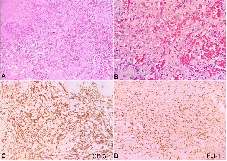 Photomicrographs of the tumor. A &ndash; subepithelial irregular vascular tumor (H&E, 10X); B &ndash;highly pleomorphic epithelioid tumor cells lining the vascular spaces (H&E, 40X); C &ndash; the tumor cells were diffusely positive for CD31 (10X); D &ndash; positive reaction to FLI-1 (10X); E &ndash; focally positive for CD34 (40X); F &ndash; focally positive for AE1/AE3 (10X).