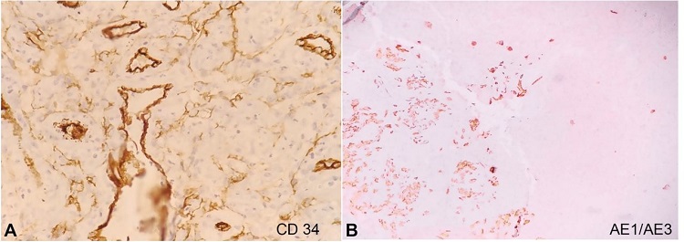 Photomicrographs of the tumor. A- Immunohistochemical reaction focally positive for CD34 (40X); and for AE1/AE3 in B (10X).