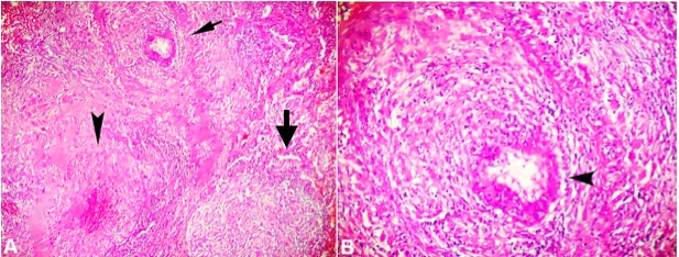 Photomicrographs of the pulmonary nodule. A – Shows a granuloma (right arrow), a granuloma with fibrinoid necrosis (arrowhead) and a granulomatous angiitis (left arrow); B – Shows granulomatous angiitis in higher magnification (black arrowhead). Fungus and mycobacteria were not found (both pictures H&E, A 100X, and B 200X).