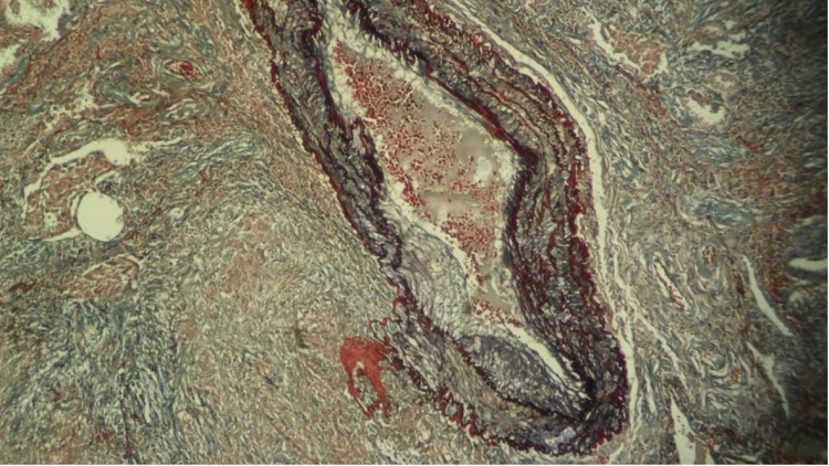 Photomicrograph of the pulmonary nodule showing a vessel injury and granuloma (Weigert-Van Gieson, 100X).