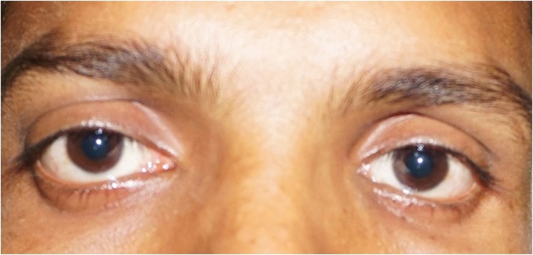 Photograph of the patient showing proptosis of the right eye.