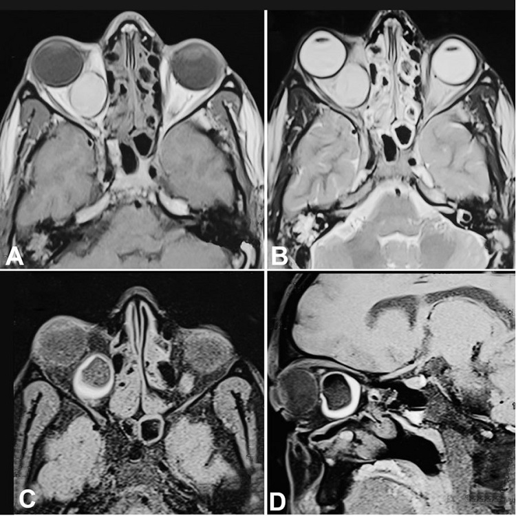 Orbit MRI. The cyst showed a hyperintense signal in both T1 (A) and T2-weighted images (B); C and D &ndash; T1- weighted image with fat-saturated sequence shows hypointense signals.