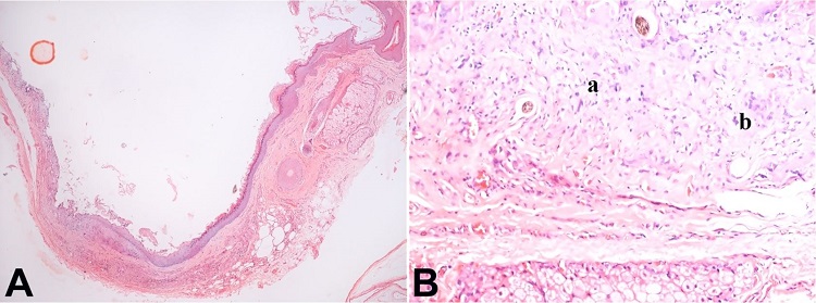 A &ndash; Photomicrograph of the cystic lesion shows the cyst wall lined by stratified squamous epithelium with keratinization and presence of adnexal structures [H&E 4x]; B &ndash; Photomicrograph shows part of cyst wall with lymphocytic infiltration (marked a) and focal foreign body giant cell reaction (marked b). [H&E 40x].
