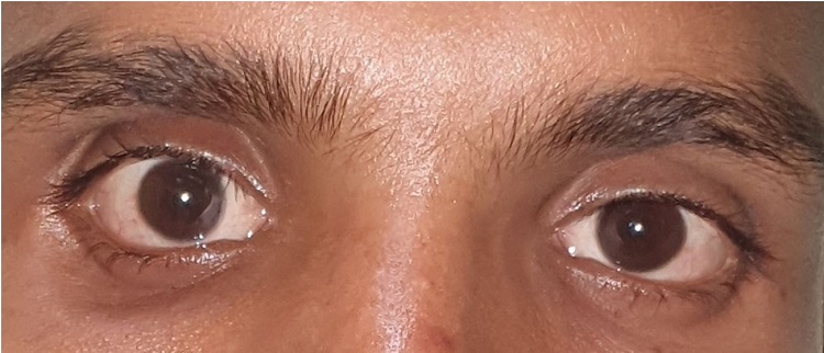 Postoperative photograph of the patient one month after the surgery.