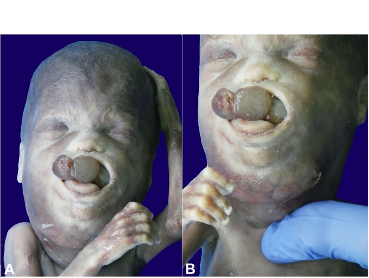 External examination. A &ndash; The lesion is minimally protruding from the mouth B &ndash; note the marked involvement of the neck.