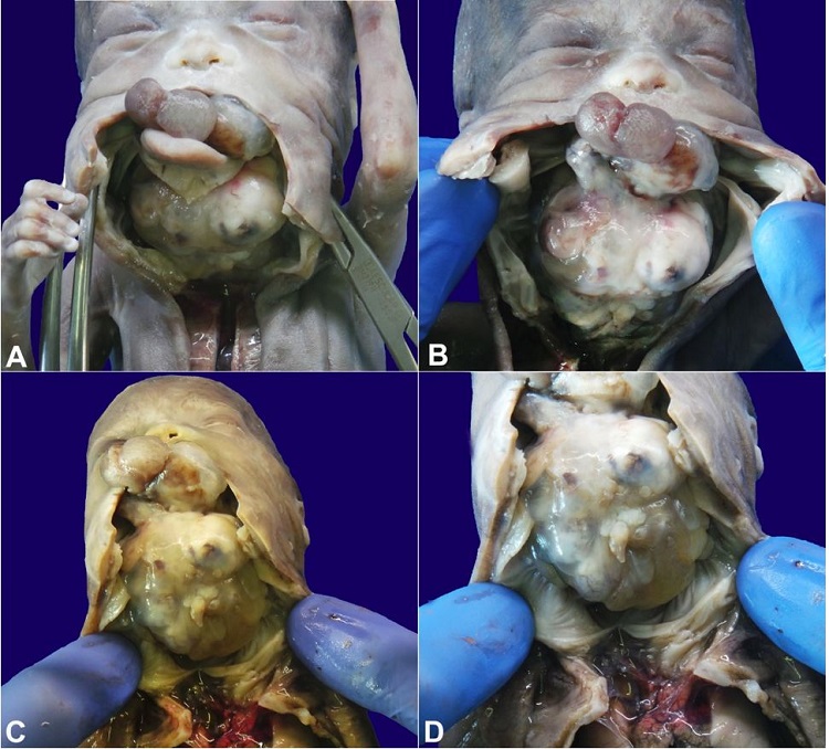 Complete view of the neoplasm. A &ndash; After a median cut (from the lower lip, to the jugular), the neoformation is seen extending throughout the oral cavity, and engulfing the tongue; B &ndash; View of the neoformation after removal of the tongue remnants; C and D &ndash; The lesion infiltrated the entire floor of the mouth, incorporating the tongue, with compression and antero-posterior displacement of the pharynx, larynx, and trachea. In particular, the root and body of the tongue were not recognizable because they were incorporated and destroyed by the neoplasm; only the apex of the tongue was identified