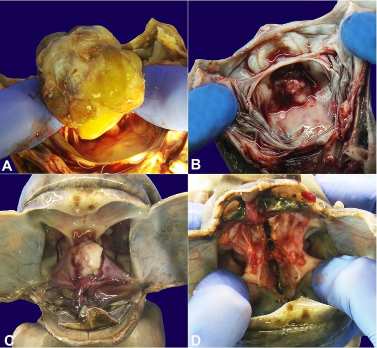 Intracranial component. A &ndash; The lesion was removed by cutting its peduncle anchored to the palate; B &ndash; The area of insertion of the lesion on the palate is exposed; C &ndash; After removal of the brain, the small intracranial part of the tumor could be identified; D &ndash; After a longitudinal cut of the sella turcica a communication can be seen between the epignathus and the intracranial component.