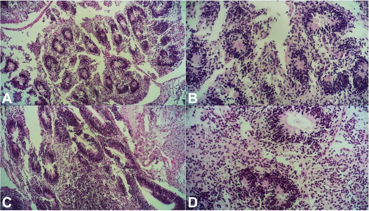 Microscopic images. The majority of the tumor is an immature teratoma composed of immature neuroepithelial tissue (A - H&E, 40X, B and C - H&E,100X, D - H&E, 200X).