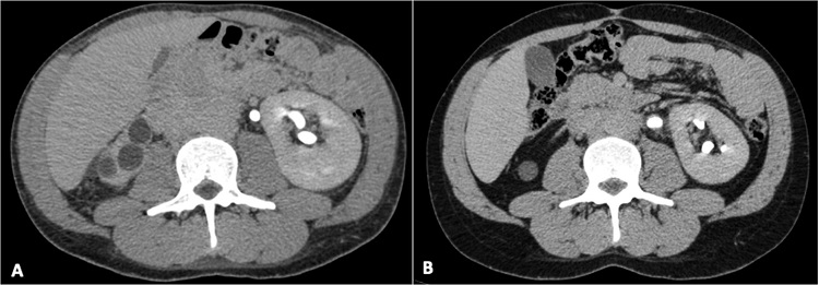 Abdominal CT axial plane: A &ndash; Initial examination on admission. Note large mass involving the abdominal aorta; B &ndash; CT scan performed 7 months after the first examination and under treatment with corticosteroid. Note the expressive reduction of the periaortic mass.