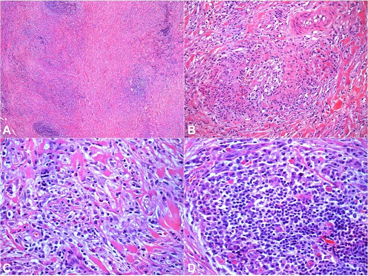 Photomicrographs of the biopsy: A &ndash; Fibro conjunctive tissue exhibiting fibrosis, with thick collagen bundles and moderate inflammatory infiltrate with lymphoid aggregates (HE &ndash; 40X); B &ndash; Obliterating phlebitis (HE &ndash; 200X); C &ndash; Fibro conjunctive stroma showing thick collagen bundles with few eosinophils, histiocytes and small lymphocytes mixed with plasma cells (HE &ndash; 400X); D &ndash; Numerous plasma cells surrounding a lymphoid aggregate (HE &ndash; 400X).