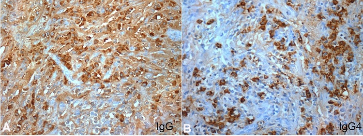 Photomicrographs of the Immunohistochemical staining of the biopsy: A &ndash; Numerous IgG positive plasma cells near a lymphoid aggregate (400X); B &ndash; Increased number of IgG4 positive plasma cells presenting an elevated IgG4/IgG ratio greater than 30% in areas of more density (400X).