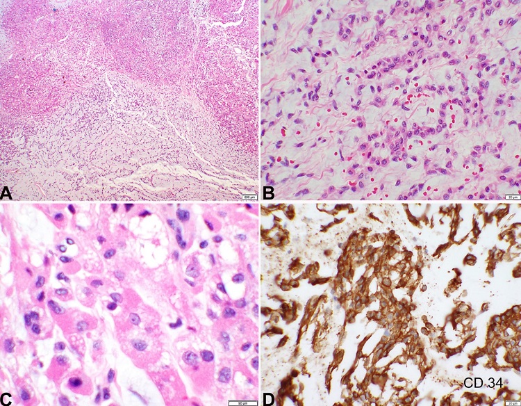 Histopathology and Immunohistochemistry. A &ndash; Low power photomicrograph of a hematoxylin and eosin stain shows the nodular architecture of the tumor with hypercellular and hypocellular regions with increased cellularity at the periphery of the lobules. The right side of the image shows pale blue myxoid matrix representing hypocellular areas. The left side, more eosinophilic appearing, shows both organoid and lobular growth patterns (2x objective); B &ndash; Abundant myxoid stroma with uniform cells arranged in trabeculae and interconnecting cords (20x objective); C &ndash; Rhabdoid cells with eccentrically located nuclei and eosinophilic to finely vacuolated cytoplasm (40x objective); D &ndash; CD34 immunohistochemical stain depicts tumor cells with intense cell membrane staining (20x objective).
