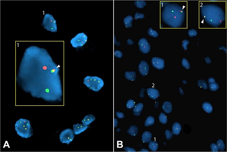 Fluorescence in Situ Hybridization (FISH). A &ndash; FISH analysis showing EWSR1 gene rearrangement at the 22q12 locus. The 5&rsquo; segment of the probe is orange and the 3&rsquo; segment green. In the inset, a magnified cell nucleus from the field shows a split probe on one chromosome (two distinctly separate orange and green dots) and an intact probe (arrow) on the other (fused orange and green signals); B &ndash; FISH analysis depicting NR4A3 (9q22.33-q31.1) gene rearrangement using another break-apart probe. The 5&rsquo; segment of the probe is orange and the 3&rsquo; segment is green. The arrows in the insets (1 & 2) point to the intact gene on one chromosome and a broken apart gene on the other chromosome.