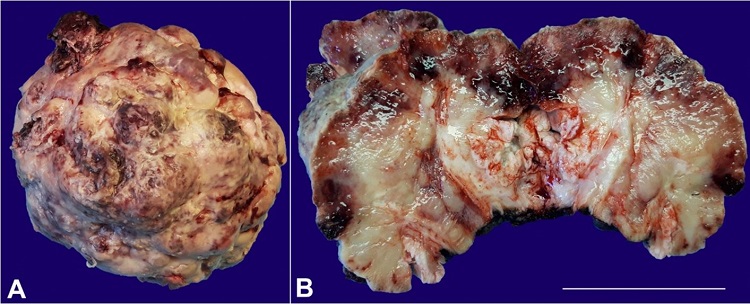 A – Macroscopic feature of the partial penectomy showing a large exophytic mass with an irregular surface; B – Macroscopic cross-section of the partial penectomy showing a gray, white and congestive tissue. Scale bar = 70mm.