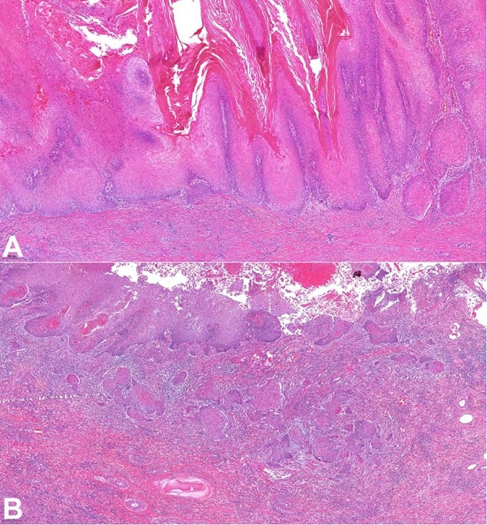 Photomicrographs of the tumor. A – Pure verrucous carcinoma component (HE 100x); B - Focus of usual invasive squamous cell carcinoma (verrucous hybrid carcinoma) (HE 100x)